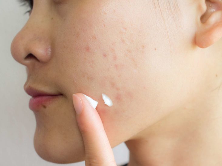 15 Treatments That Help Fade Even the Most Stubborn Acne Scars