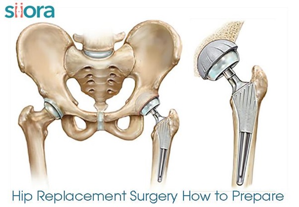 Hip Replacement Surgery – How to Prepare