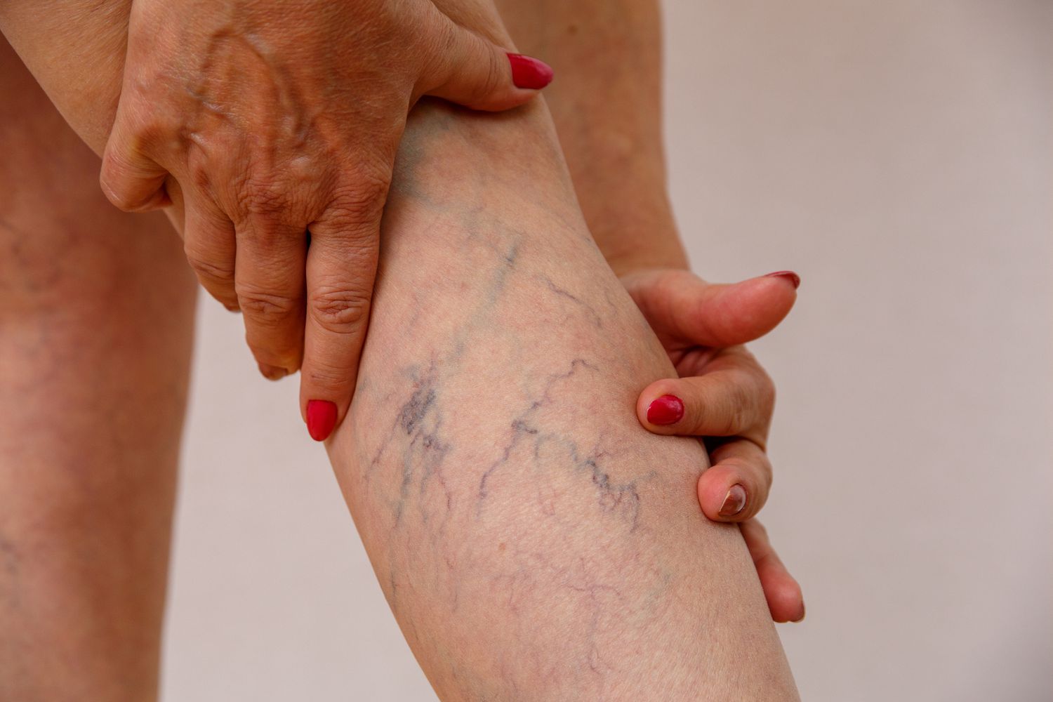 Understanding Varicose Veins and How to Take Control of Vascular Health